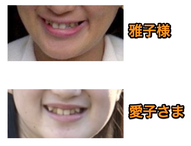 雅子様と愛子さまの歯並び比較
